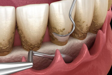 Periodontics