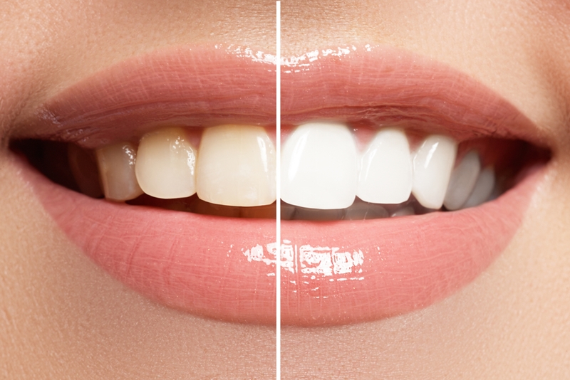 bleaching-teeth-whitening-in-gurgaon