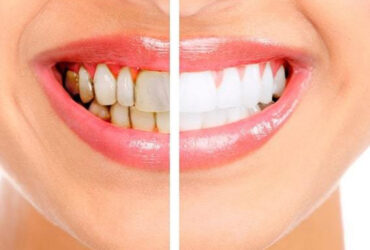 Teeth Whitening