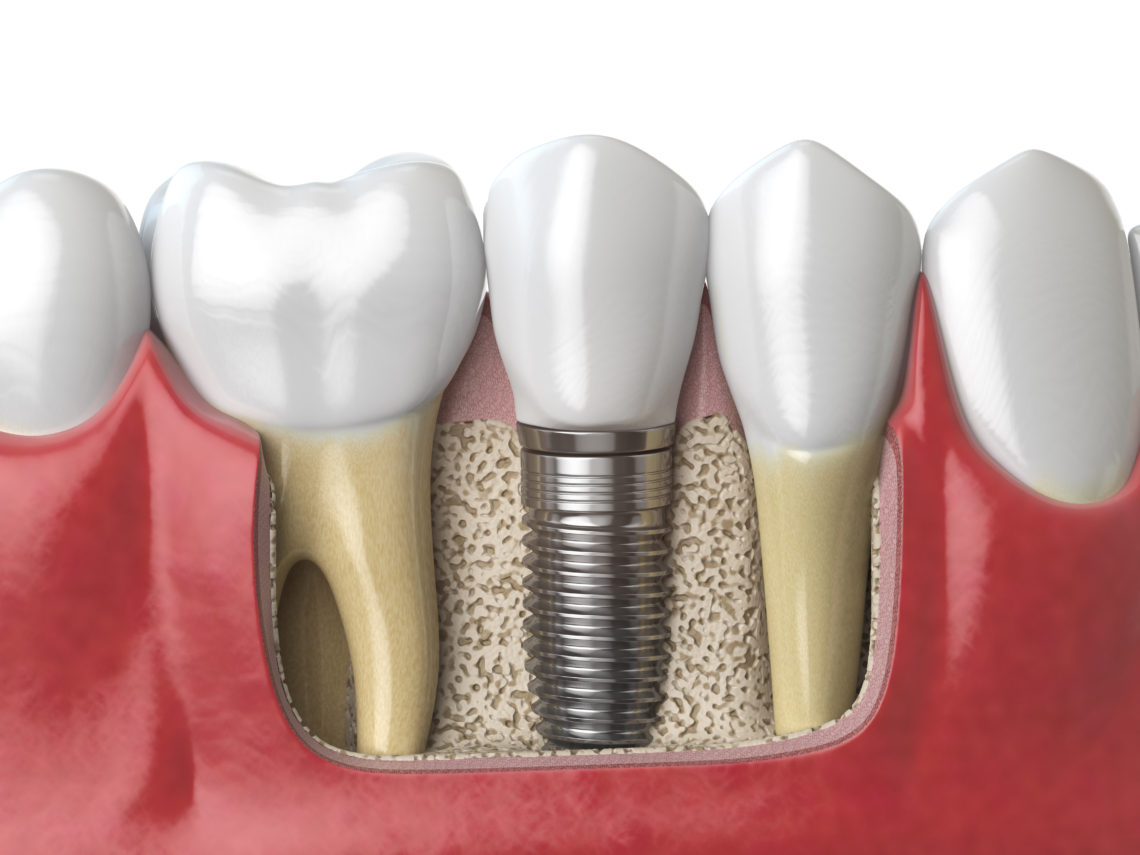 what dental implants can do