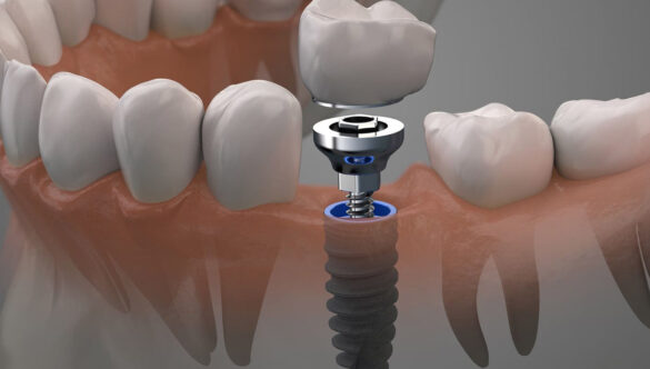 How behind a Dental Implant Procedure