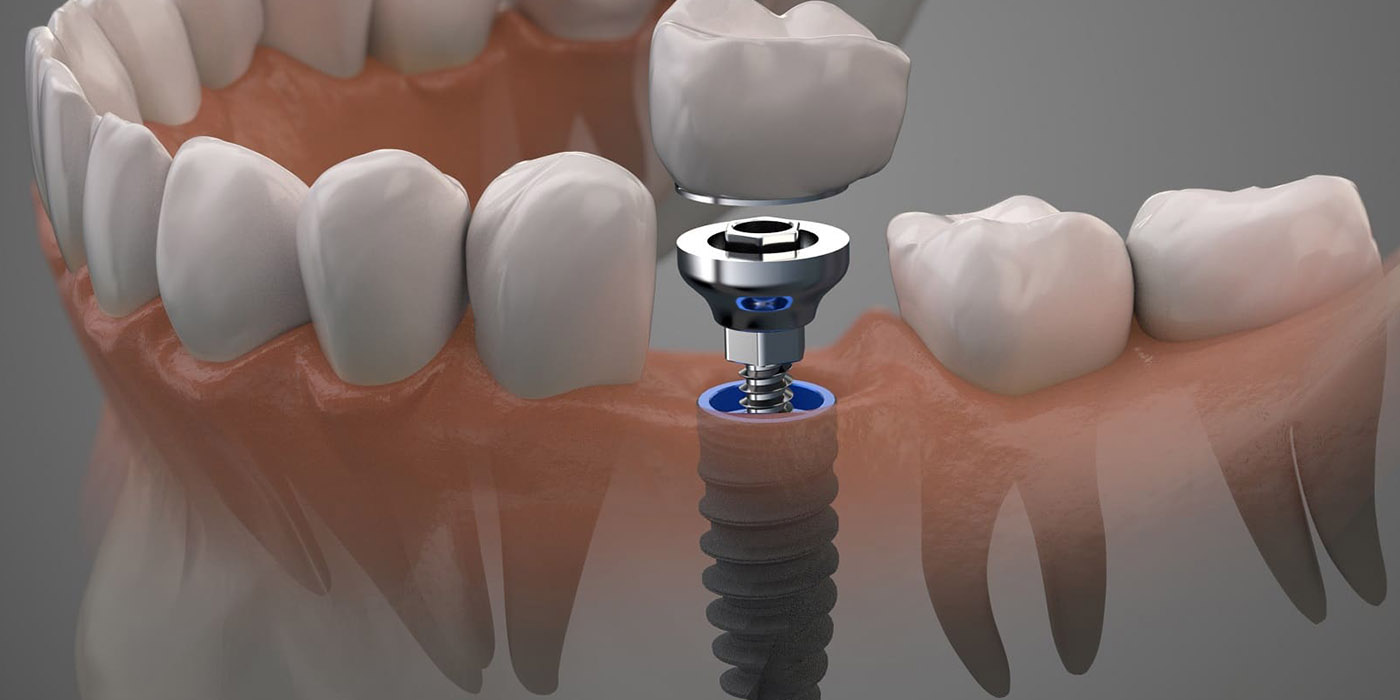 How behind a Dental Implant Procedure