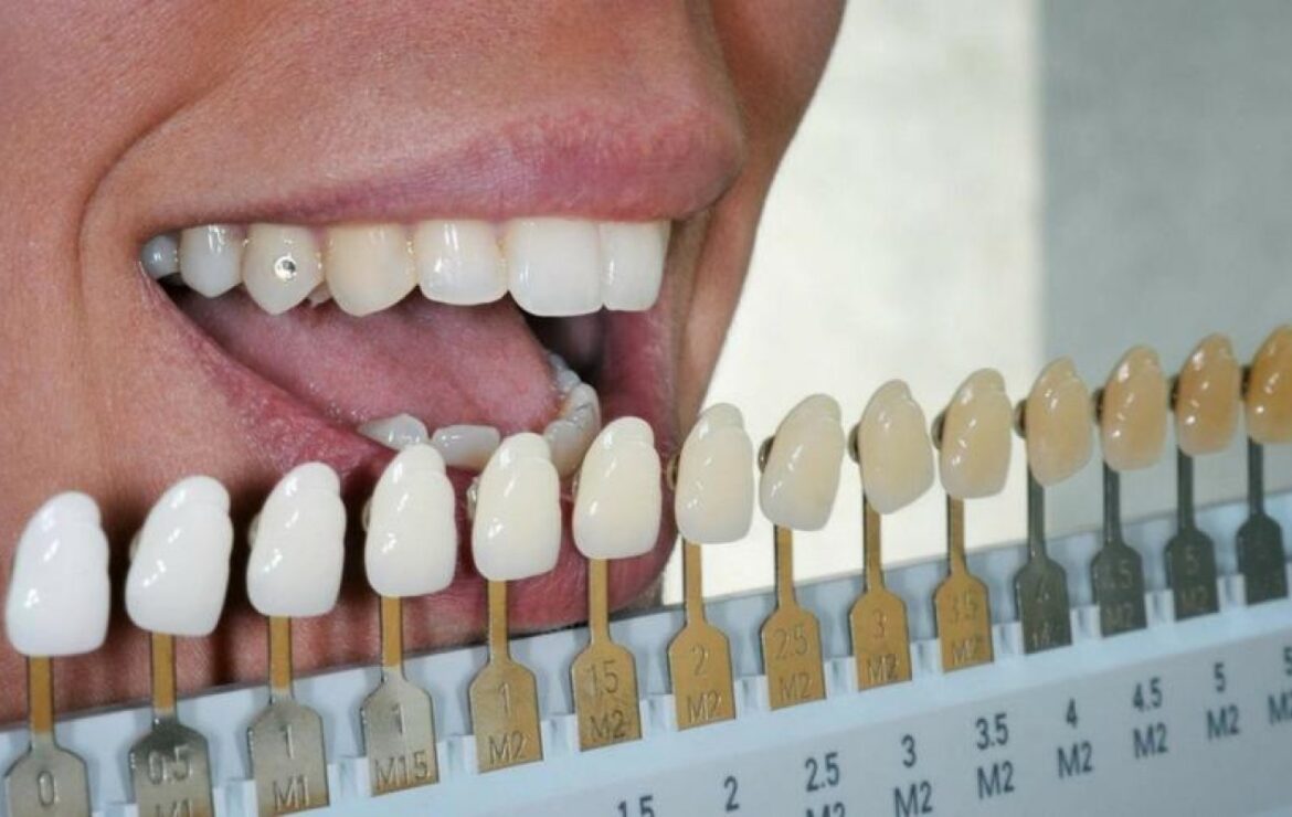 Factors that Influence the Color of Teeth