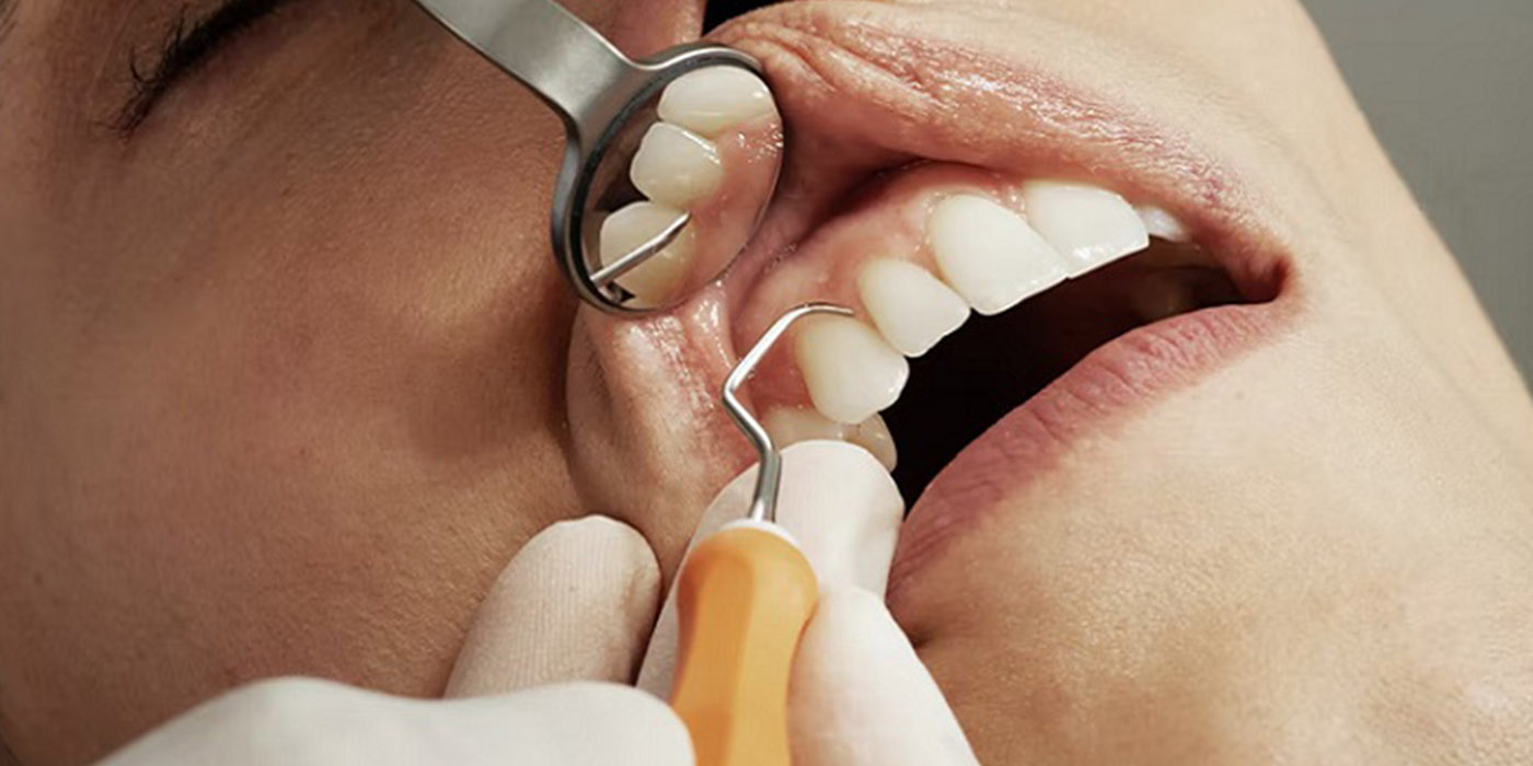 Root Canal Treatment- A Step by Step Guide