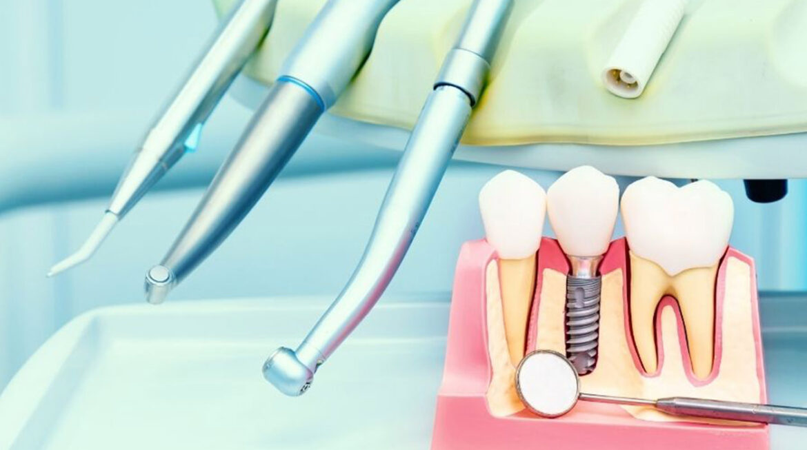 What are the Different Types of Dental Implants?