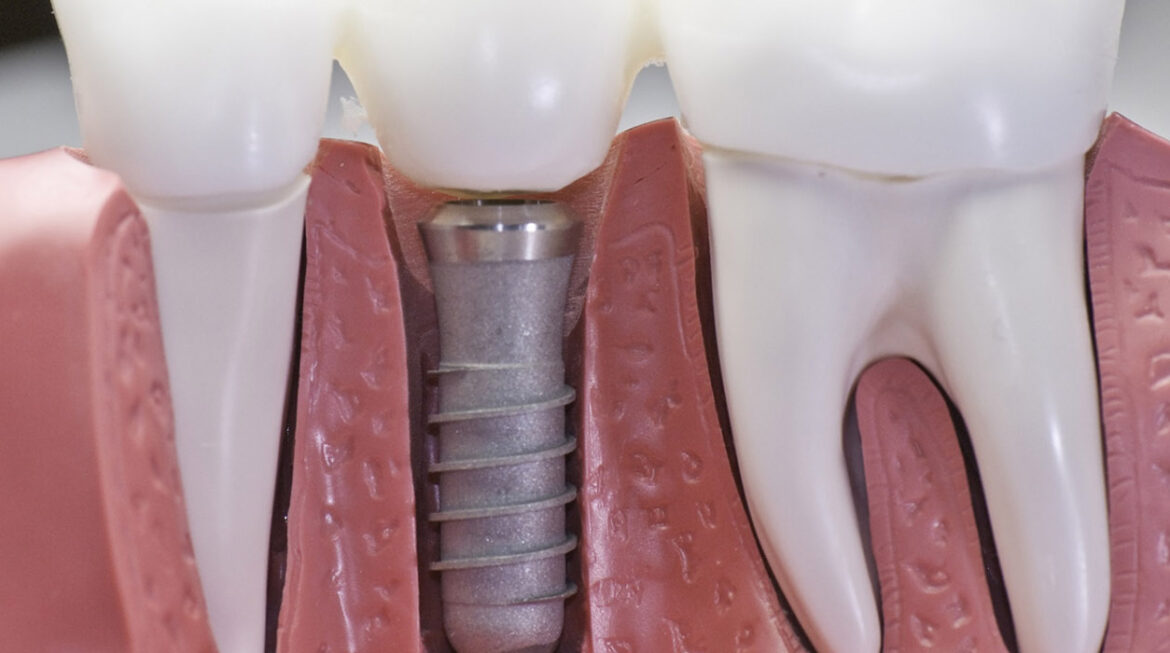 Difference Between Root Canal Treatment and Dental Implant