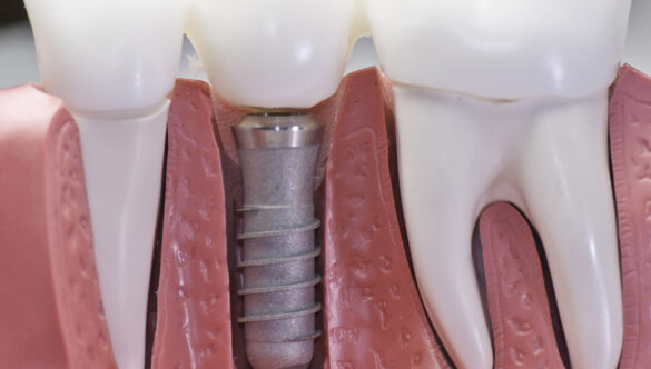 Difference Between Root Canal Treatment and Dental Implant