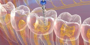 Root-Canal-Treatment in gurgaon