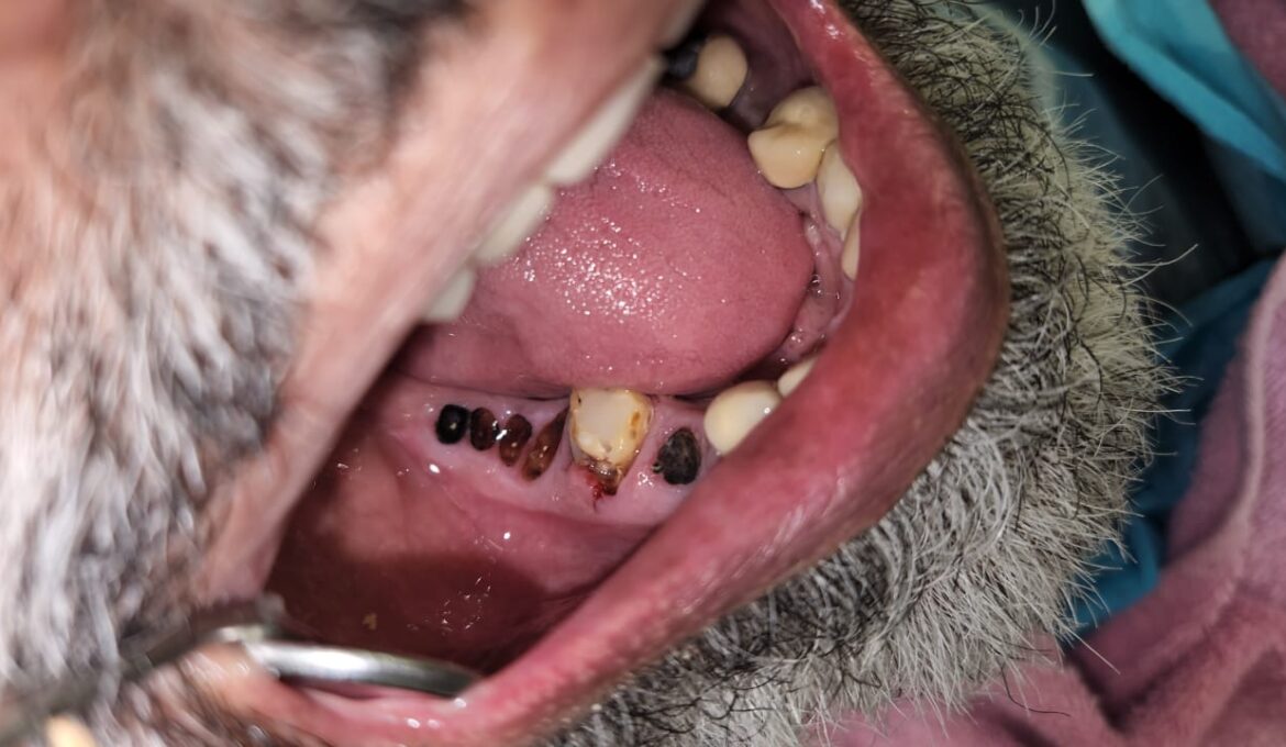 dental implants case 1