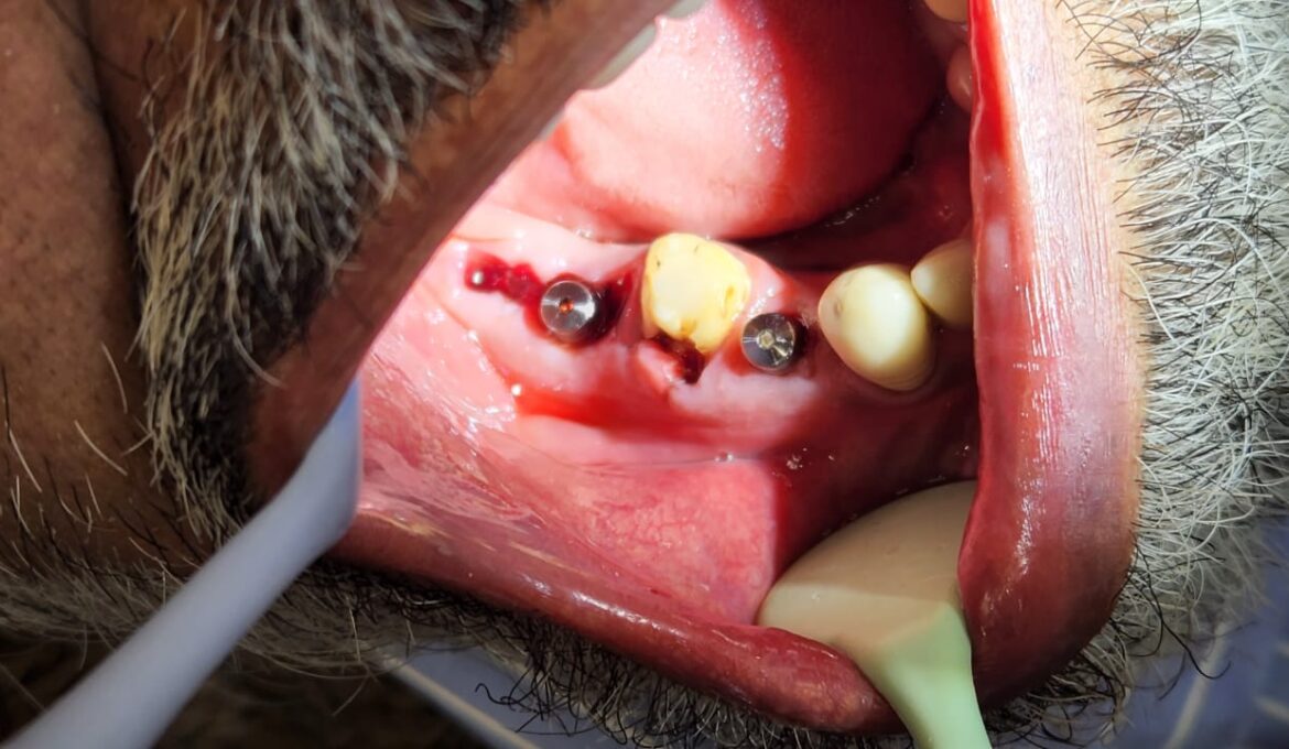 dental implants case 1-2