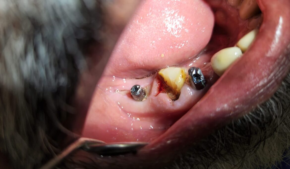 dental implants case 1-3