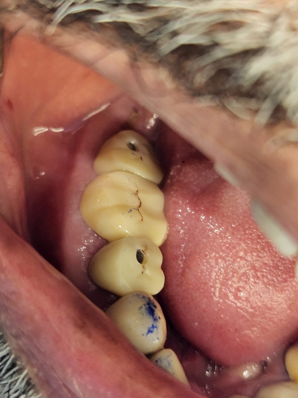dental implants case 1-4