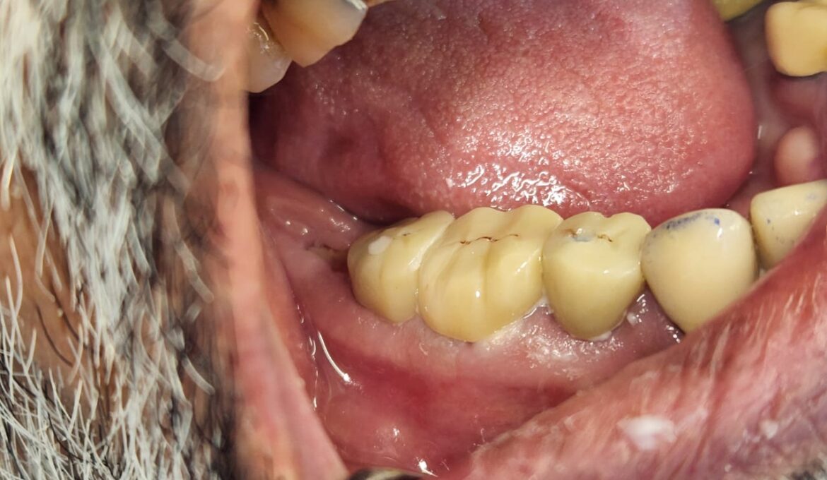 dental implants case 1-5