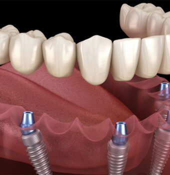 Dental Implants in Gurgaon : Procedure Benefits Cost & Aftercare