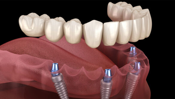 Dental Implants in Gurgaon : Procedure Benefits Cost & Aftercare