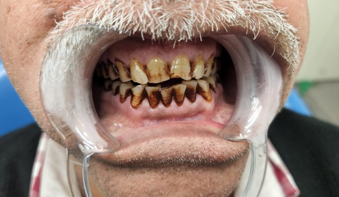 teeth scaling 1