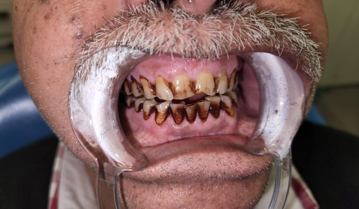 teeth scaling 2