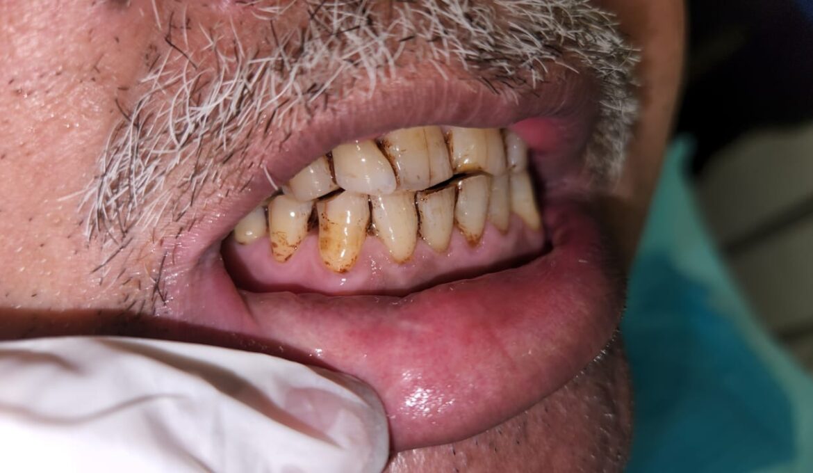 teeth scaling 3