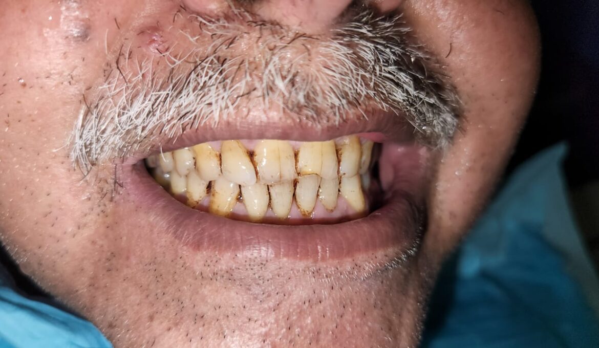 teeth scaling 4