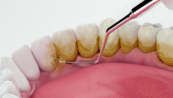 Teeth Scaling/Cleaning in Gurgaon at Most Advanced Dental Centre