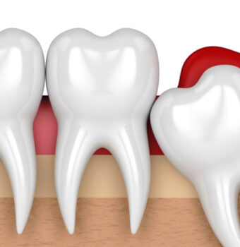 Wisdom Tooth Extraction in Gurgaon