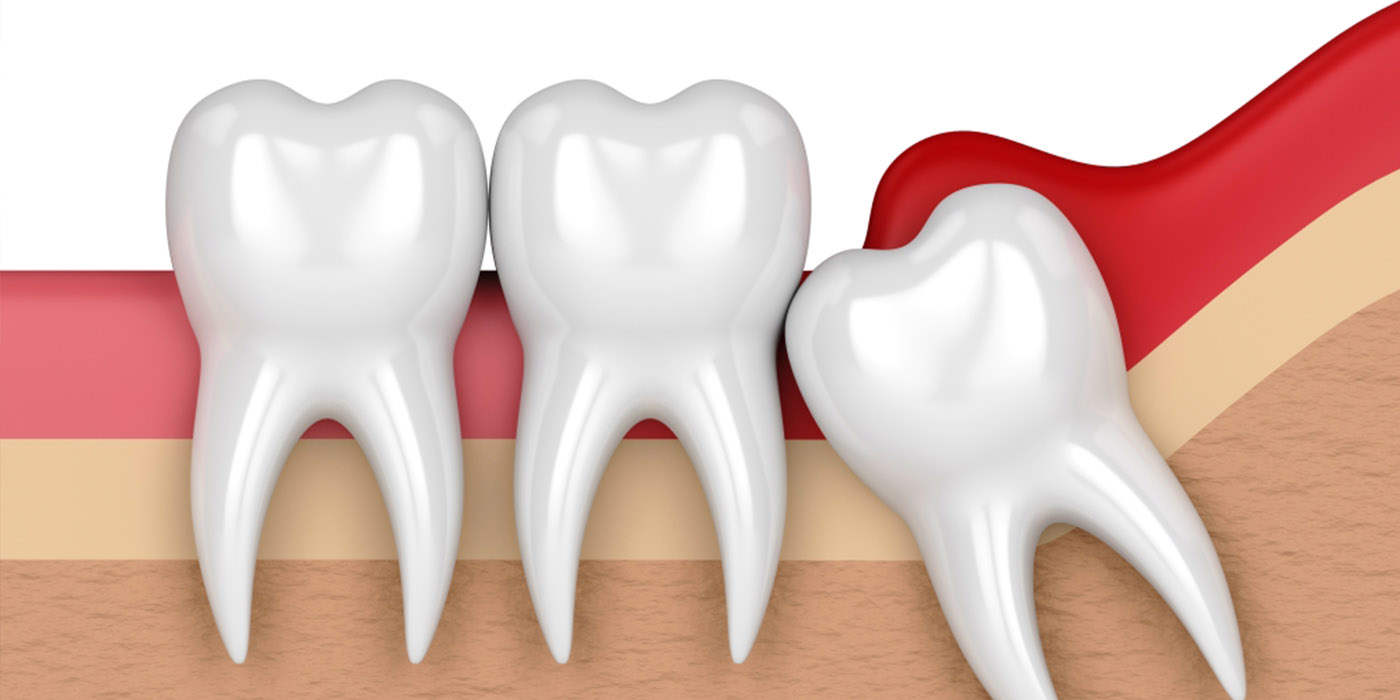 Wisdom Tooth Extraction in Gurgaon