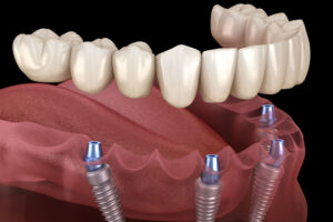 Full Teeth Replacement Cost in Gurgaon