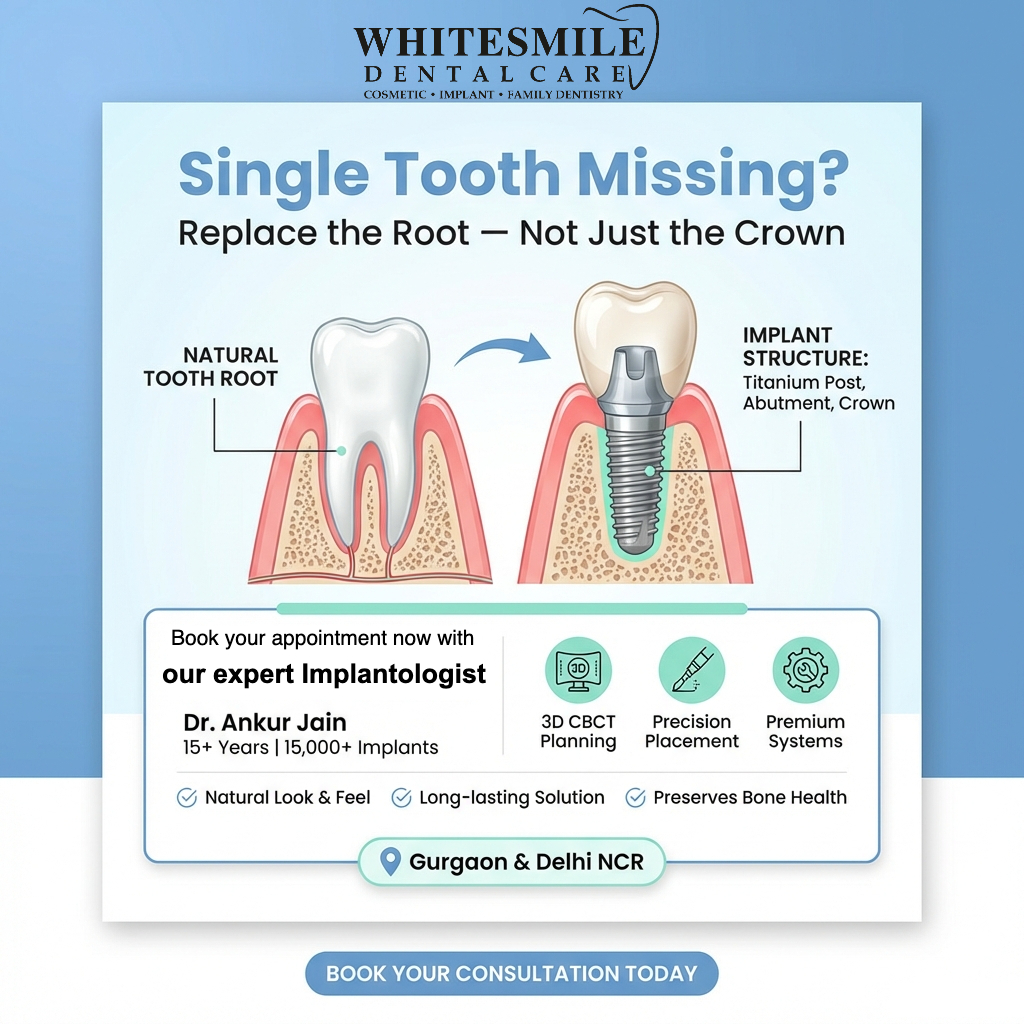 Single Tooth Implants- A Complete Clinical Guide by Dr.Ankur Jain, Best Implantologist Gurgaon